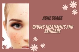 Acne Scars: Causes, Treatments & Skincare That Works