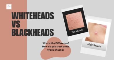 Whiteheads vs Blackheads