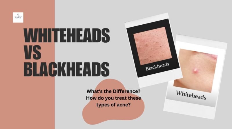 Whiteheads vs Blackheads