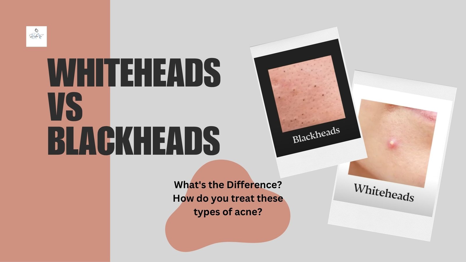 Whiteheads vs Blackheads: Causes & Effective Treatments
