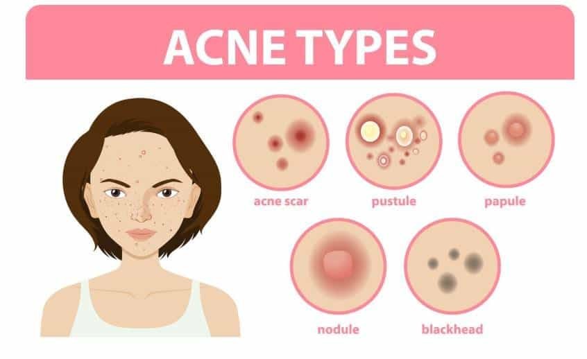 acne scars type